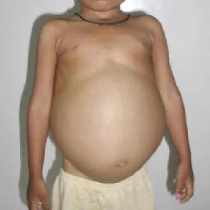 Gaucher Disease